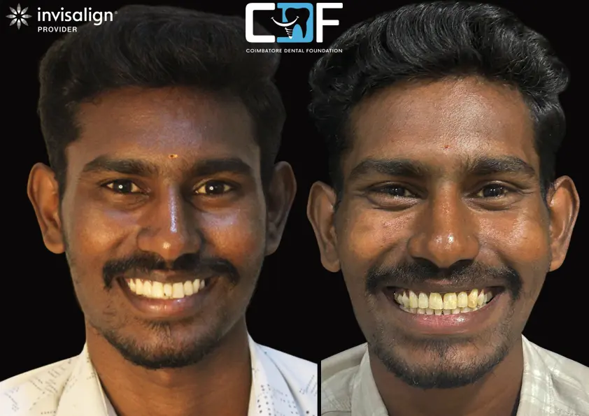 Dhaya Invisalign Before After
